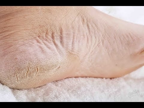 Cách làm sạch gót chân nhanh chóng và hiệu quả